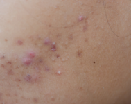 The Best Effective Way to Get Rid of Acne Scars