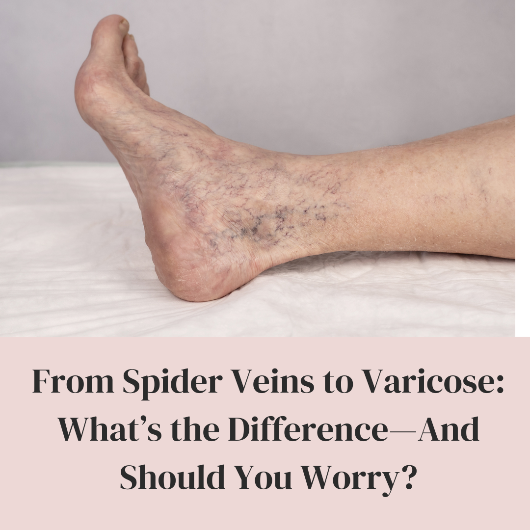 From Spider Veins to Varicose What’s the Difference And Should You Worry