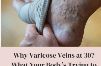 Varicose Veins at 30 What Your Body’s Trying to Tell You