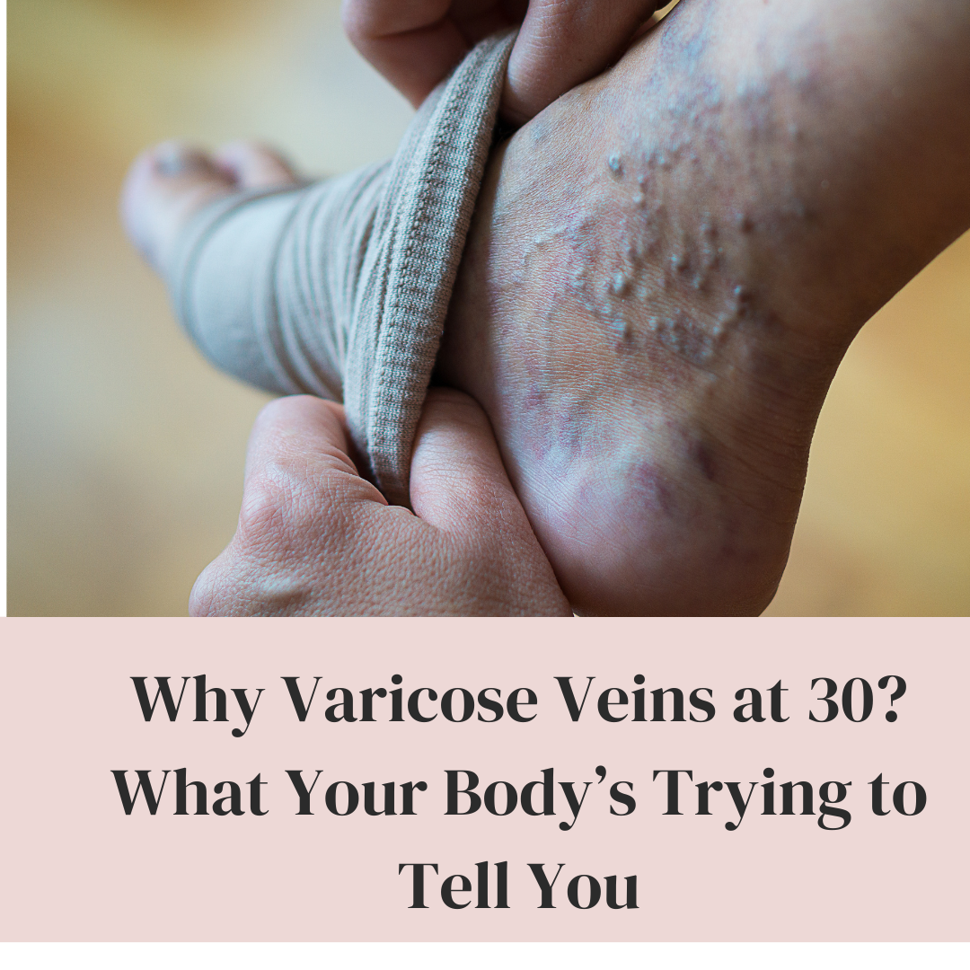 Varicose Veins at 30 What Your Body’s Trying to Tell You
