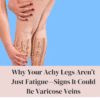 Why Your Achy Legs Aren’t Just Fatigue Signs It Could Be Varicose Veins