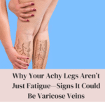 Why Your Achy Legs Aren’t Just Fatigue Signs It Could Be Varicose Veins