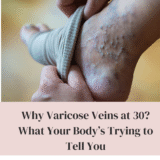 Varicose Veins at 30? What Your Body’s Trying to Tell You