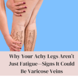 Why Your Achy Legs Aren’t Just Fatigue—Signs It Could Be Varicose Veins
